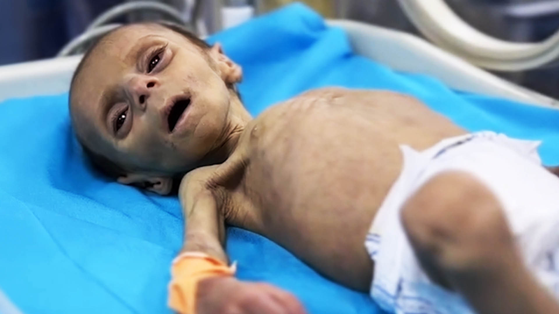 Ce B b Gazaoui Victime De La Malnutrition Caus e Par Le Blocus 